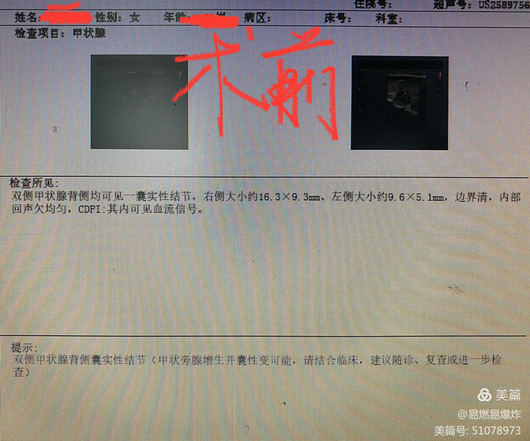 我院胸外科成功独立完成抚州首例双侧甲状旁腺全切除+自体甲状旁腺移植术 我院胸外科成功独立完成抚州首例双侧甲状旁腺全切除+自体甲状旁腺移植术
