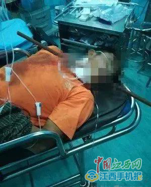 抚州市第一人民医院:多科配合成功抢救一下颌被钢筋刺穿男子的生命 抚州市第一人民医院:多科配合成功抢救一下颌被钢筋刺穿男子的生命