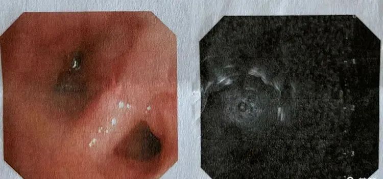 我院呼吸与危重症医学科开展超声支气管镜小探头引导下肺活检术(EBUS- TBLB) 我院呼吸与危重症医学科开展超声支气管镜小探头引导下肺活检术(EBUS- TBLB)