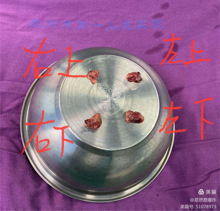 我院胸外科成功独立完成抚州首例双侧甲状旁腺全切除+自体甲状旁腺移植术 我院胸外科成功独立完成抚州首例双侧甲状旁腺全切除+自体甲状旁腺移植术